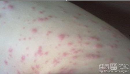 皮肤过敏可以吃雄瓜吗,雄瓜或致过敏反应